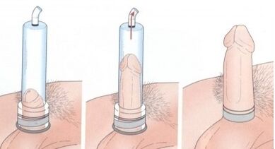 Agrandissement du pénis à l'aide d'une pompe